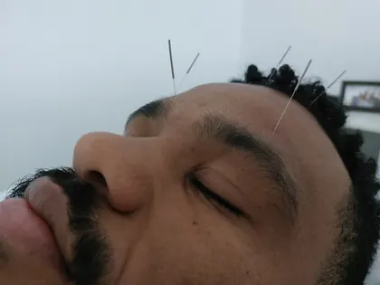 Paciente durante tratamento de enxaqueca com acupuntura