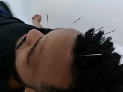 Sessão de acupuntura para tratamento de dores em Guarulhos